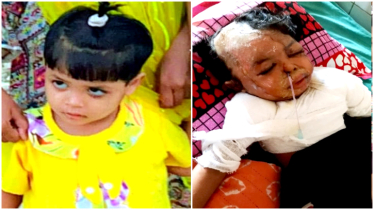 ফুটন্ত গরম পানিতে জ্বলসে শিশু জান্নাতুলের করুণ পরিণতি, অসহায় বাবার আকুতি