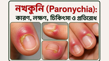 নখকুনি (Paronychia): কারণ, লক্ষণ, চিকিৎসা ও প্রতিরোধ